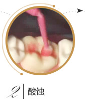 儿童口腔窝沟封闭流程二