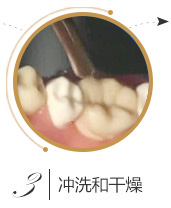 儿童口腔窝沟封闭流程三