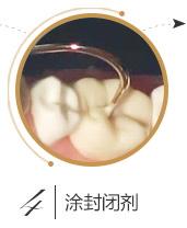 儿童口腔窝沟封闭流程四