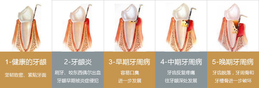 牙周病变史
