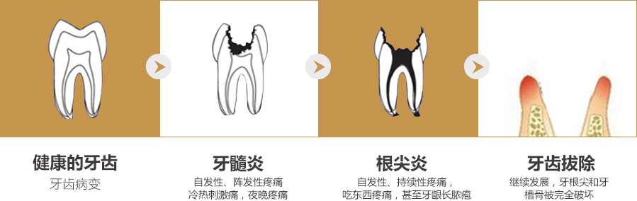 德贝美牙周治疗技术