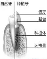 种植牙