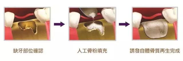 种植牙