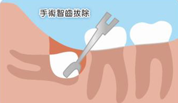 拔一颗智齿一般要多少钱(图1)