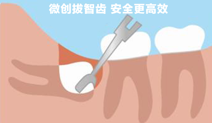 拔智齿多少钱一颗2021价格表(图1)