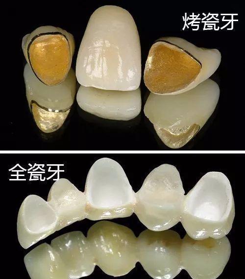 烤瓷牙和全瓷牙哪个好(图1)