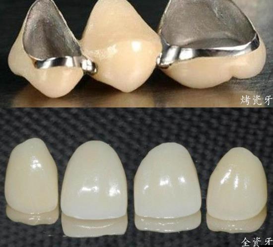 烤瓷牙和全瓷牙的优缺点(图1)
