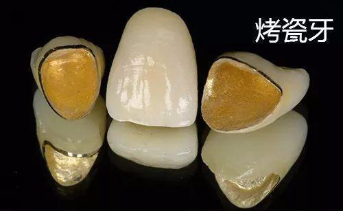 烤瓷牙掉了怎么办(图1)
