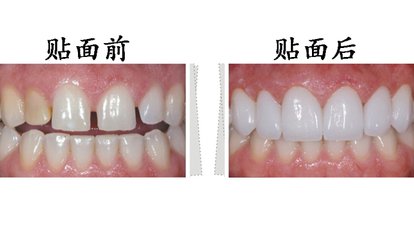 瓷贴面牙齿有危害吗(图1)