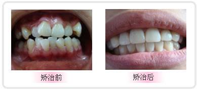 牙齿矫正要拔牙吗(图1)