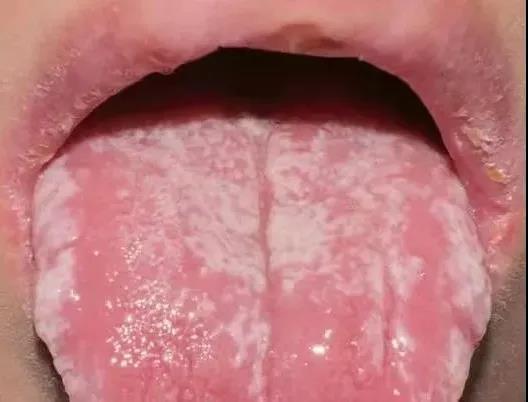 本以为是牙龈炎，结果是艾滋病？(图1)