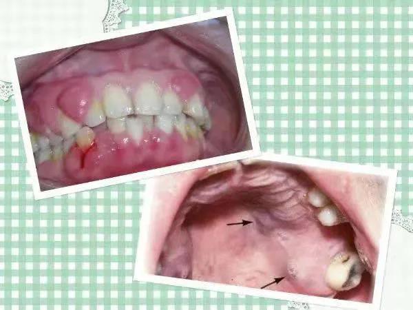 本以为是牙龈炎，结果是艾滋病？(图5)