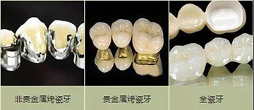 牙冠修复后注意事项(图1)
