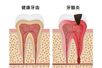 牙髓炎治疗流程有哪些(图1)